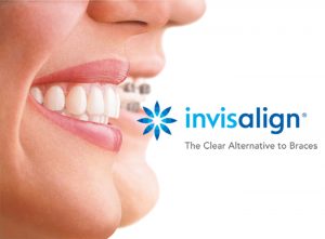 Cartel de Invisalign