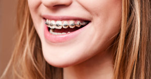 Brackets tradicionales vs. brackets autoligables: ¿Cuál elegir?