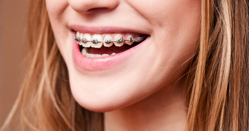 Brackets tradicionales vs. brackets autoligables: ¿Cuál elegir?