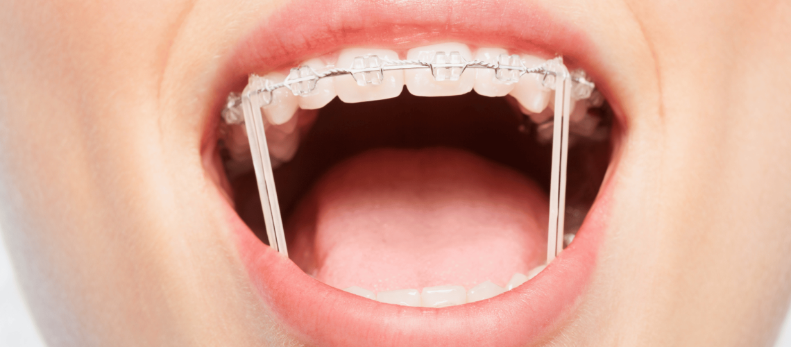 gomas elásticas en tu ortodoncia