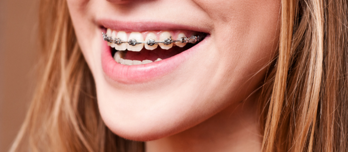 Brackets tradicionales vs. brackets autoligables: ¿Cuál elegir?